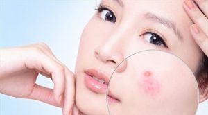 Bị nóng trong người thì nên ăn uống như thế nào?